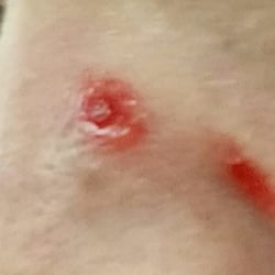 Daniels David, MD - The Daniels Group - Before Dr. Daniels repaired a deep gash on my nose. I thought I would definitely have a huge scar