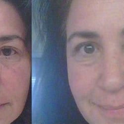 Eyesite Vision Center - From bad to all healed. Thank you Dr Goberville!