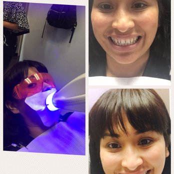 Cosmetic Micro Dentistry - 1st time ever doing the Teeth whitening.... just in time for my wedding. My results are amazing!!! - Cosmetic Dentists Near Me - Montclair, California