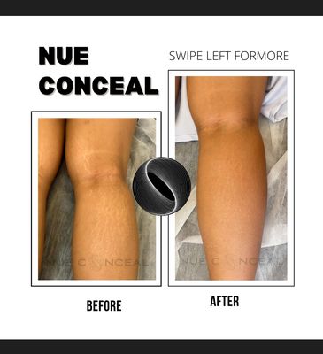 INKLESS AND CAMOUFLAGE REVISION - These are clients that underwent inkless and camouflage revision from different parts of the bodies. Depend on each client, result varies on all skin types and depths of scars and stretch marks. We use the most advanced NUE CONCEAL serum to treat each individual. Session can be either one to couple sessions for the outcome the client is looking for. Each clients have their own journey and Skin Confidence Studio is here to walk every steps of the way with you. INKLESS AND CAMOUFLAGE REVISION - These are clients that underwent inkless and camouflage revision from different parts of the bodies. Depend on each client, result varies on all skin types and depths of scars and stretch marks. We use the most advanced NUE CONCEAL serum to treat each individual. Session can be either one to couple sessions for the outcome the client is looking for. Each clients have their own journey and Skin Confidence Studio is here to walk every steps of the way with you.