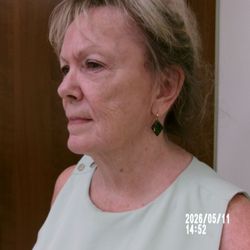 Farahmand Plastic Surgery - Before