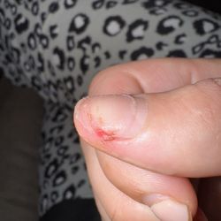 Wynn Nails & Hair - Ripped off nail from acrylic removal