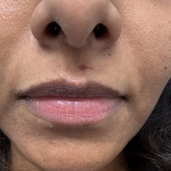 Aricha Beauty Salon - Bruised upper lip and it's 3 days , it is not going away!