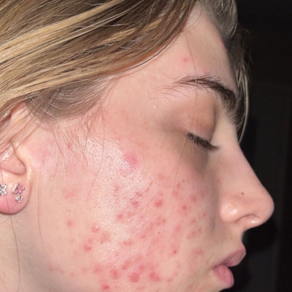 My skin right before my first chemical peel appointment with Savannah