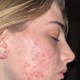 My skin right before my first chemical peel appointment with Savannah My skin right before my first chemical peel appointment with Savannah