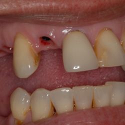 James Khazian, DMD - Dental Implant Centers - Replacement of 3 missing upper teeth with dental implants