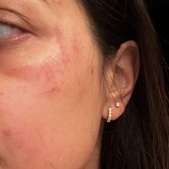 Face to Face Spa - Shortly after the facial - Medical Spas Near Me - Austin, Texas