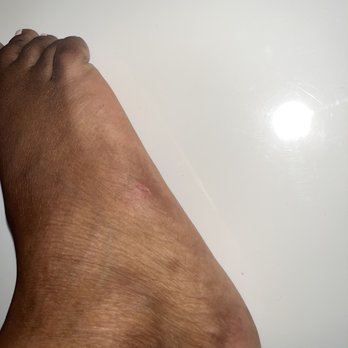 Tipsy Nails & Spa - Picture of cut on side of foot from grater done by mail attendant Tiffany - Nail Salons Near Me - Missouri City, Texas