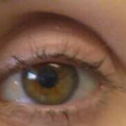Benjamin Lam - Hollowed out upper eyelid with no crease