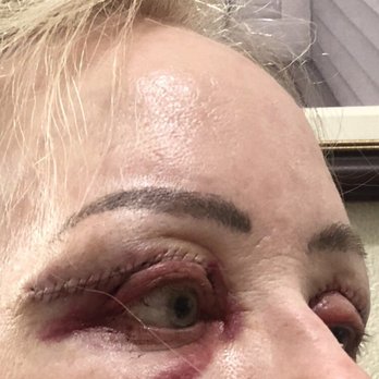 Victor Lacombe, MD - 5/29/18 Surgery Date. This is one week after. Note the incision line way above the crease. I now have a visible scar here. - Cosmetic Surgeons Near Me - Santa Rosa, California Victor Lacombe, MD - 5/29/18 Surgery Date. This is one week after. Note the incision line way above the crease. I now have a visible scar here. - Cosmetic Surgeons Near Me - Santa Rosa, California