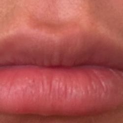 Cosmetic Injectables By Lisa - 1 week after lip filler