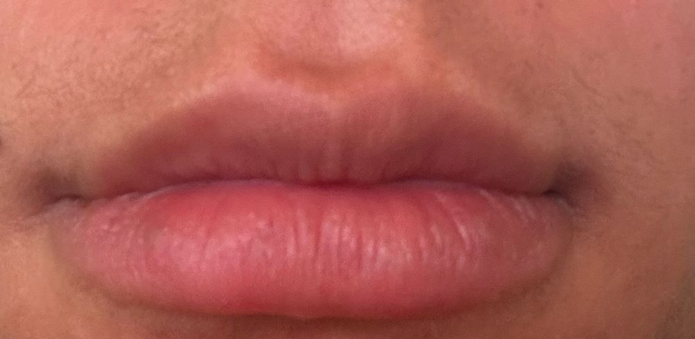 Cosmetic Injectables By Lisa