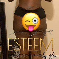 Esteem Body Contour by Kei - Post op lymphatic massages are everything!