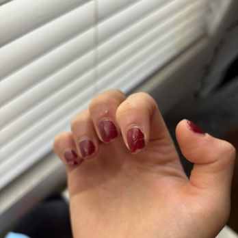 Athens Nails & Lashes - One of the broken nails before the infection. - Nail Salons Near Me - Johns Creek, Georgia