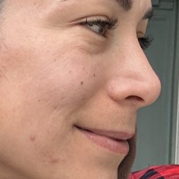 4 years post-op Side profile