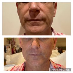 Skin Remedies - Before and after my 2nd visit: this specifically showing the filler work done that day.