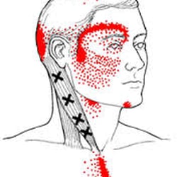 Reform Physical Therapy - Trigger points in your neck can lead facial pain and ringing in your ears.