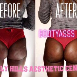 Beverly Hills Aesthetic Centers - Bootylift