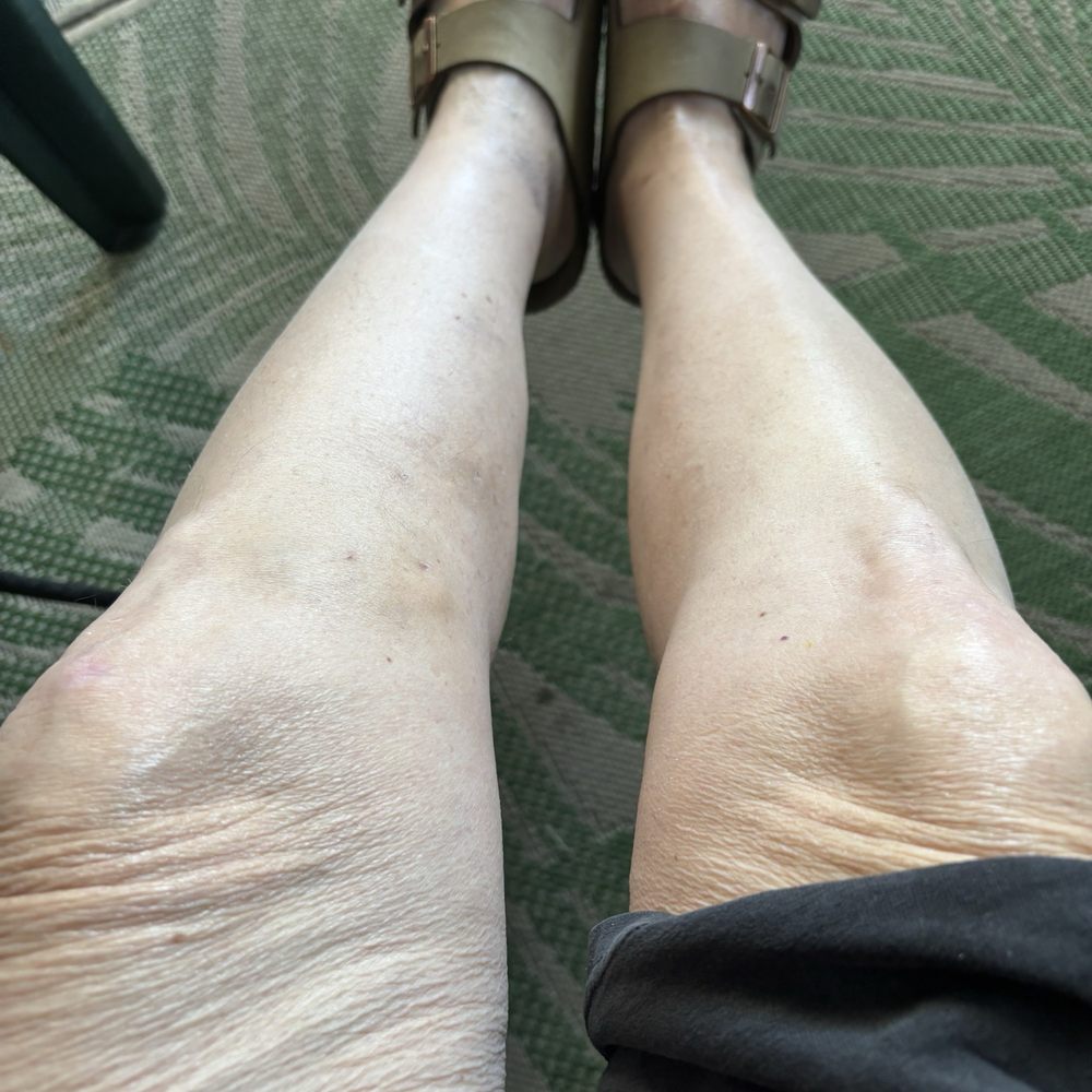 Advanced Vein Center - Post procedures: both legs looking better! No pain! - Phlebologists Near Me - Orange, California Advanced Vein Center - Post procedures: both legs looking better! No pain! - Phlebologists Near Me - Orange, California