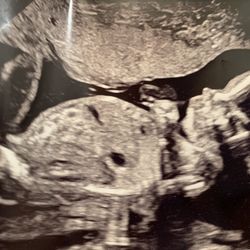 Elisa Yao, MD - 20 week ultrasound of our healthy baby girl!