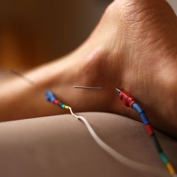 Pain Free Acupuncture - We also offer electrostimulation. - Acupuncture Near Me - Millcreek, Utah Pain Free Acupuncture - We also offer electrostimulation. - Acupuncture Near Me - Millcreek, Utah