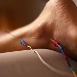 Pain Free Acupuncture - We also offer electrostimulation.