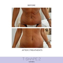 Kukui Lifestyle Medicine Clinic - Before and After 3 T-Shape 2 treatments