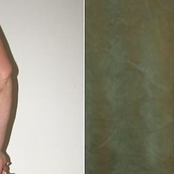 Shlomo Widder, MD - Tummy tuck before and after