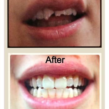 Avanti Dentistry - Composite veneers in just one appointment after a bad accident - Cosmetic Dentists Near Me - Tysons, Virginia