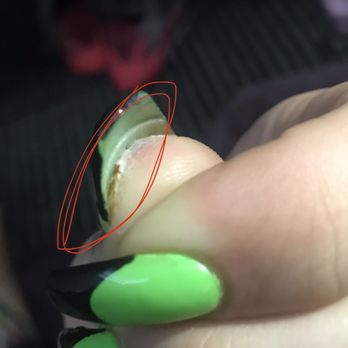 Sun Nails - The blister popped and the skin is separating from the nail. - Nail Salons Near Me - Los Angeles, California Sun Nails - The blister popped and the skin is separating from the nail. - Nail Salons Near Me - Los Angeles, California