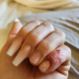 Fungal infection Fungal infection