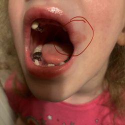 Centers for Pediatric Dental Sedation - The LARGE wound left on my babies lip from them rushing and hurting her.