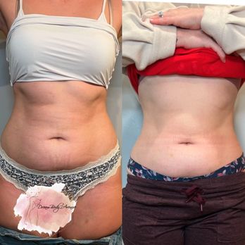 Dream Body Avenue - Body Contouring Near Me - Roseville, California Dream Body Avenue - Body Contouring Near Me - Roseville, California