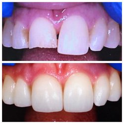 Perfect Smiles Family Dentistry - Teeth whitening with one porcelain crown and front bondings replaced