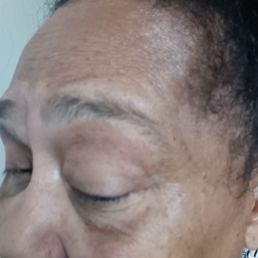 Irritated eye after botched eyebrow waxing Irritated eye after botched eyebrow waxing