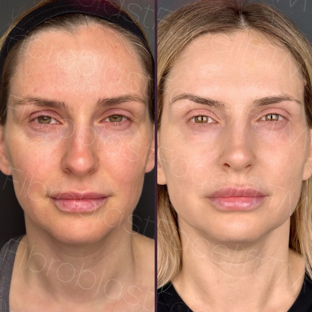 Fibroblast Facelift - Before/After - Skin Care Near Me - Pasadena, California