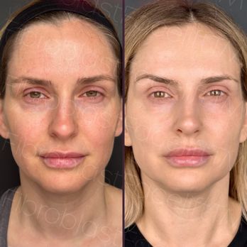 Fibroblast Facelift - Before/After - Skin Care Near Me - Pasadena, California Fibroblast Facelift - Before/After - Skin Care Near Me - Pasadena, California