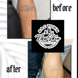 New Skin Tattoo Removal