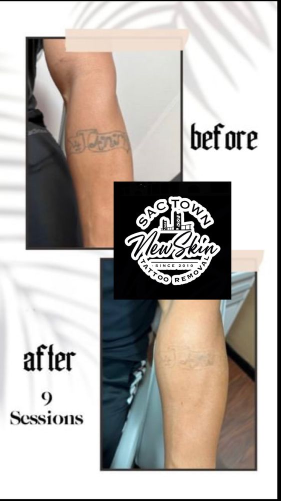New Skin Tattoo Removal - social services organization in San Jose, CA