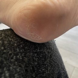 Still have calluses after pedicure Still have calluses after pedicure