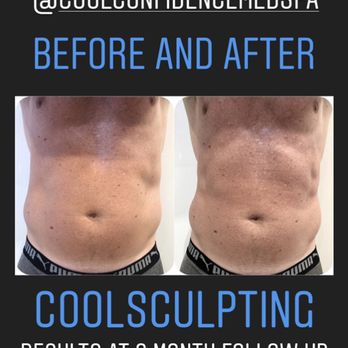 Cool Confidence - Our before and afters of CoolSculpting - Medical Spas Near Me - New York, New York Cool Confidence - Our before and afters of CoolSculpting - Medical Spas Near Me - New York, New York