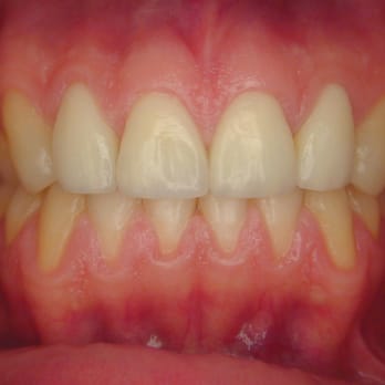 Steven J Rosenstein, DMD - This result was after Orthodontics and gum reshaping before the crowns were placed on the front 4 teeth. - General Dentistry Near Me - Aventura, Florida Steven J Rosenstein, DMD - This result was after Orthodontics and gum reshaping before the crowns were placed on the front 4 teeth. - General Dentistry Near Me - Aventura, Florida