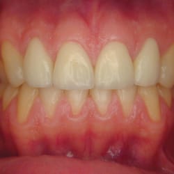 Steven J Rosenstein, DMD - This result was after Orthodontics and gum reshaping before the crowns were placed on the front 4 teeth.