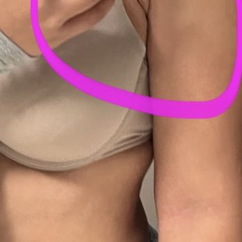 John Compoginis, MD - He re did this one 3 times and it's sewn together like a mini vagina it is so humiliating - Cosmetic Surgeons Near Me - Newport Beach, California