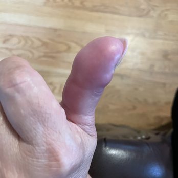 Classic Nails - Infected Finger - Nail Salons Near Me - Atlanta, Georgia