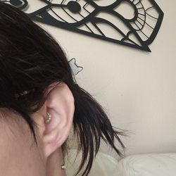 Antoine Hallak, MD - My ear about 4 weeks after the guaged ear repair surgery.