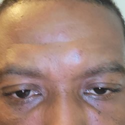 Einstein at Germantown - I have a lump on my forehead. It's been there for years but it just swelled up and started hurting....