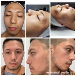 Elemental Aesthetics - Deep Sea non chemical peel
Top : Before
Bottom : 1 week after
Noticeable improvement on ice pick acne scarring