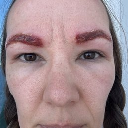 Severe bacterial infections in eye brows Severe bacterial infections in eye brows