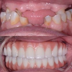 Darryl Burke, DDS - Upper and lower All on 4 for terminal dentition